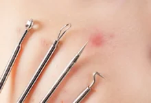 كيف أتخلص من حب الشباب